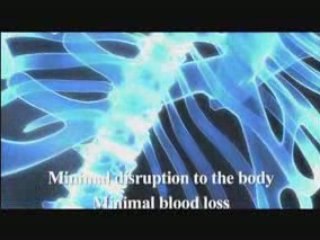 Lumbar disc replacement from Bonati