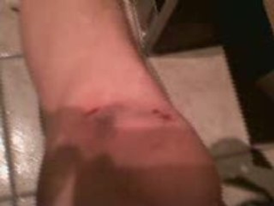 blessures après chute en scoot