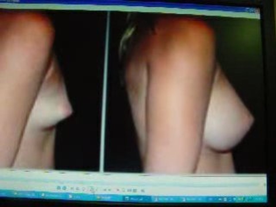 CONSULTANT  COSMETIC DR. KAMAL HUSSEIN .silicone breast augm