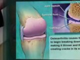 Osteoarthritis Is Common - Get Uncommon Relief With OmegaXL