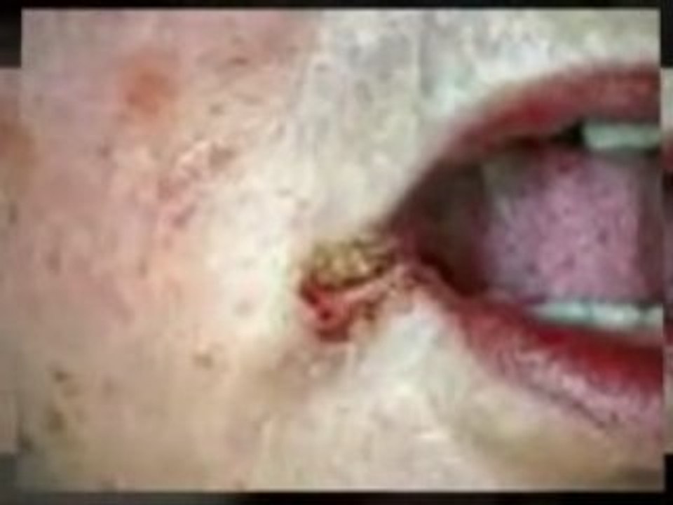 Cure Yeast Infection On Thighs