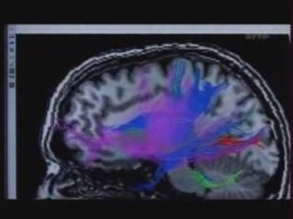 Effet de l'Alcool sur les capacités intéllectuelles - P1