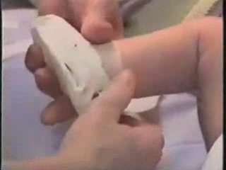 Traitement fonctionnel du pied bot varus equin