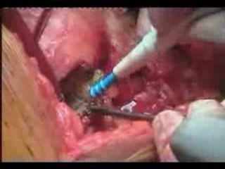 Hip Resurfacing India