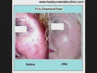 Chemical Peel Harley Cosmetic Clinic