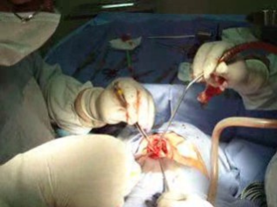 عملية تجميل الانف,جراحة تجميل المنخار,RHINOPLASTY OPERATIONS