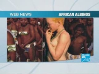 Murders of African albinos