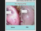 TCA Chemical Peel Harley Cosmetic Clinic