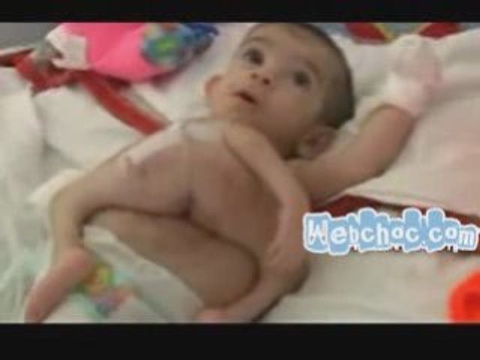 Un bébé né avec son frère accroché à son corps