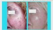 Skin Treatments Harley cosmetic Clinic Acne & Pigmentation