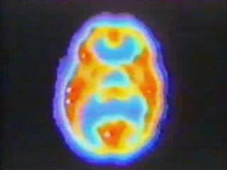 TEP: Desarrollo cerebral infantil