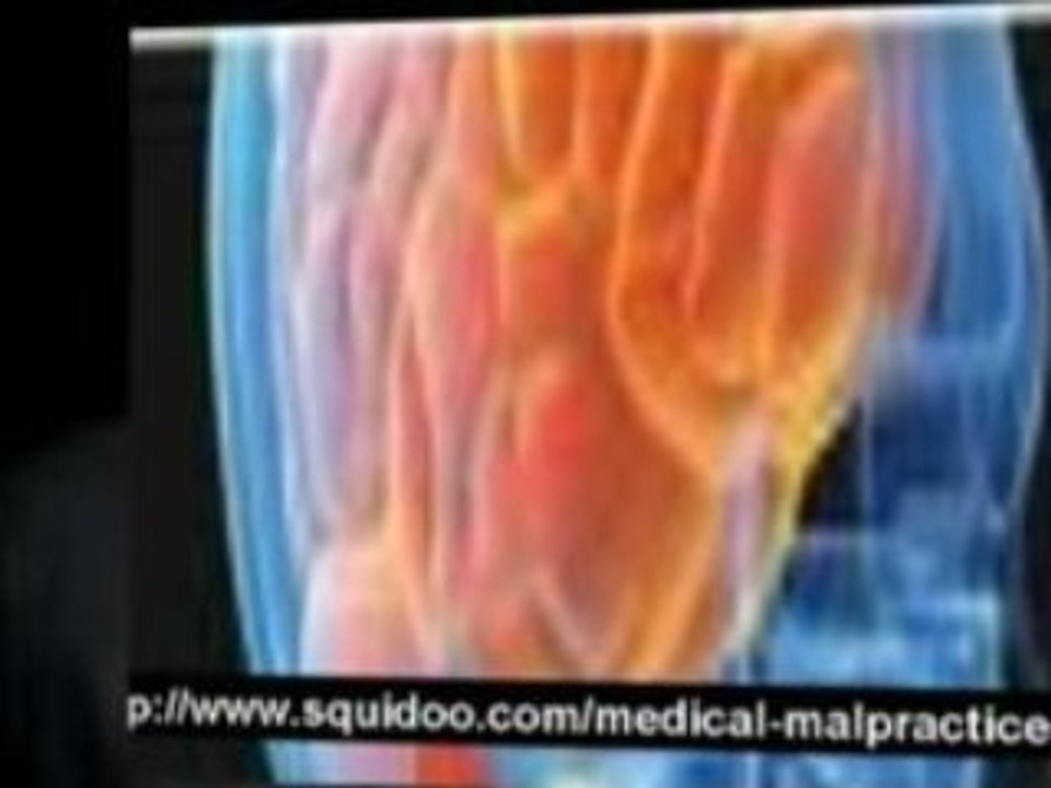 malpractice tort