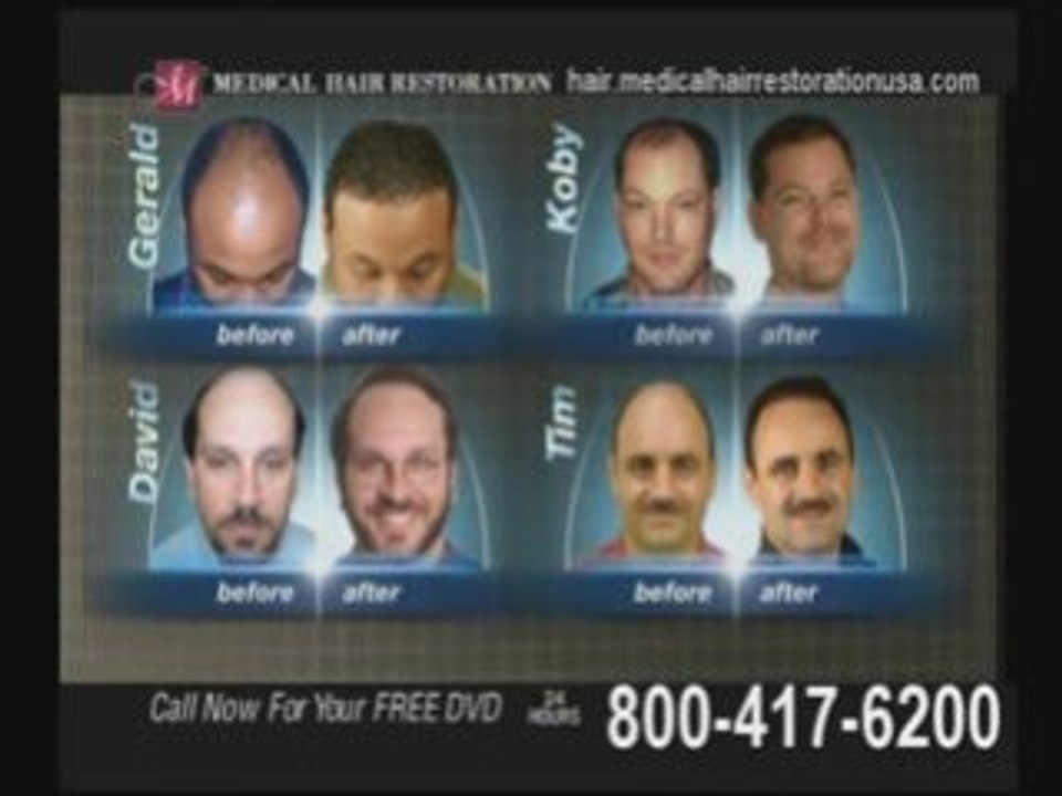 Information on Laser hair removal