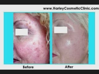 Skin Treatments TCA Chemical Peel