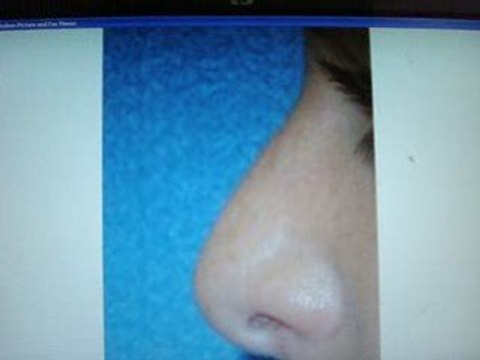 rhinoplasty-septoplasty in qatar-doha-تجميل الانف في قطر