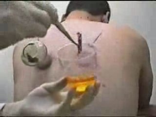 se soigner par Hijama