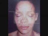 Rihanna After Beating - LEAKED Rihanna Pictures Reveal Bruis