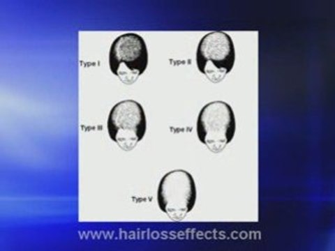 Several Causes Of Thinning Hair Or Hair Loss