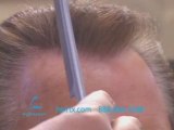 HAIR TRANSPLANT IN DALLAS, TEXAS CLOSE-UP RESULT, 10 MONTHS