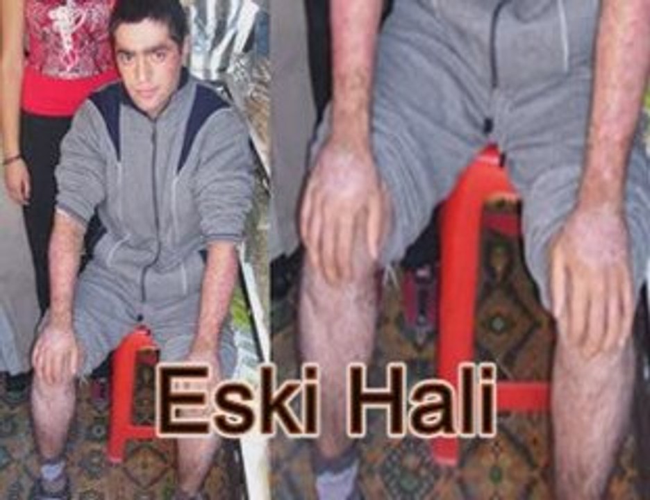 sedef hastalıgından iyilesen konuk... ANKARA