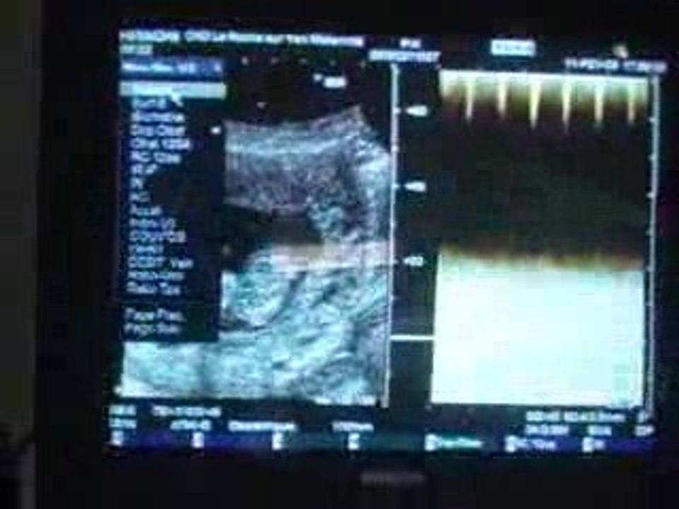 echographie 1ere trimestre nini