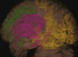 Cerebro consciente: Split brain