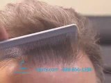 HAIR TRANSPLANT DALLAS CLOSEUP VIDEO 2009