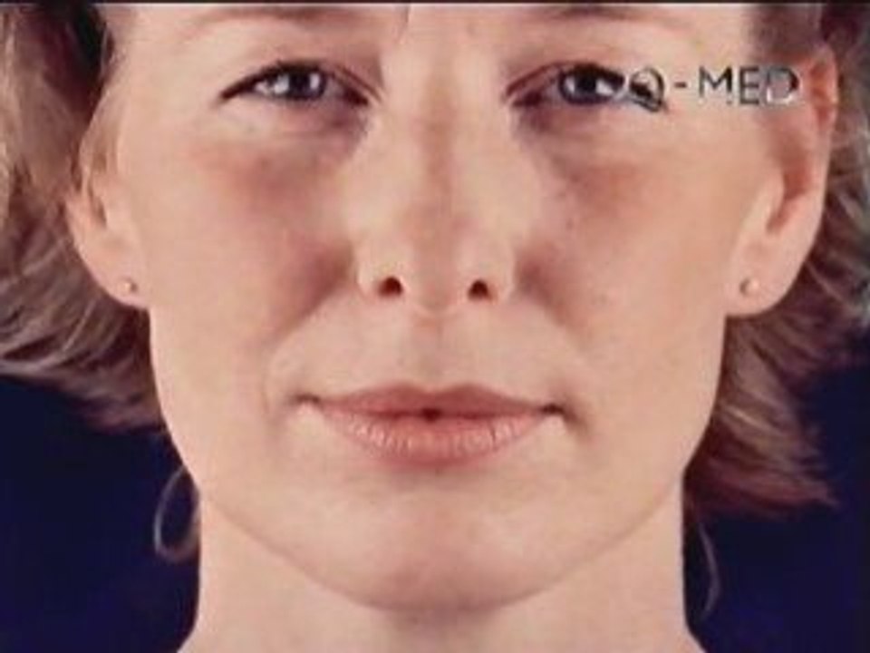 Restylane - Hyaluronsäure-Gel zur Behandlung von Falten