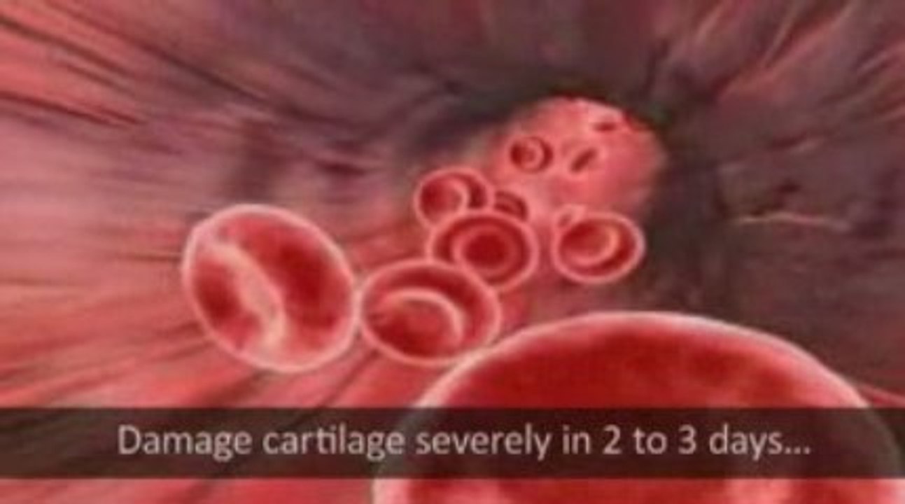 Shoulder Pain Pump Injuries Explained