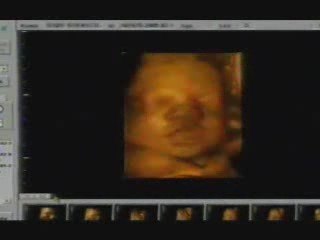 3D and 4D Ultrasounds