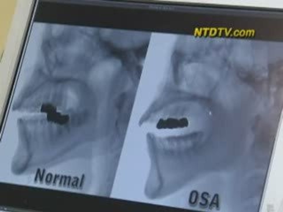 New Hope for Snorers