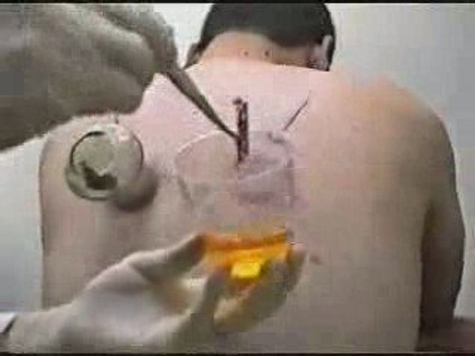 Hijama,