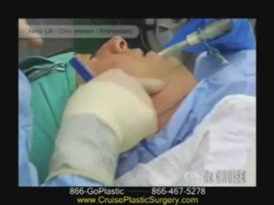 Orange County Neck Lift Surgery