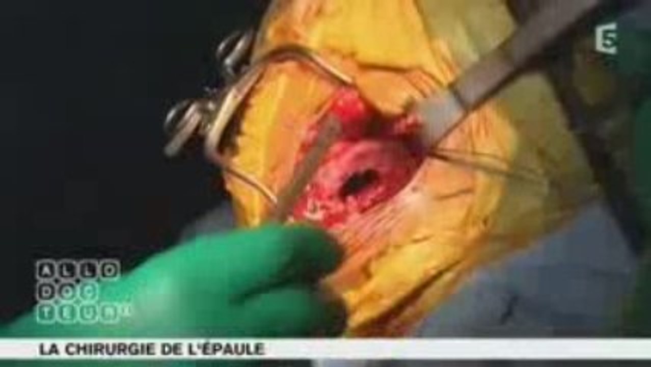 Chirurgie de l'épaule Partie 1