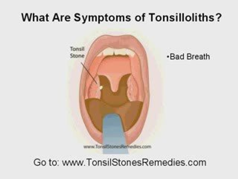 Tonsilloliths