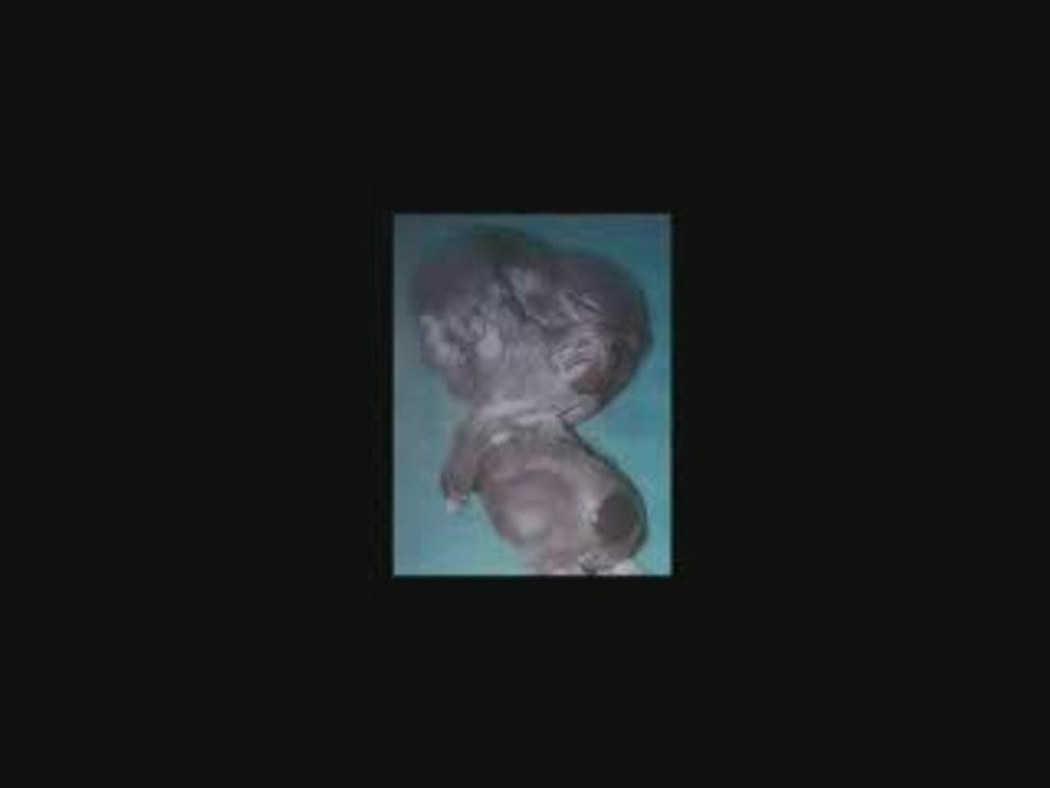 Génocide nucléaire en Irak