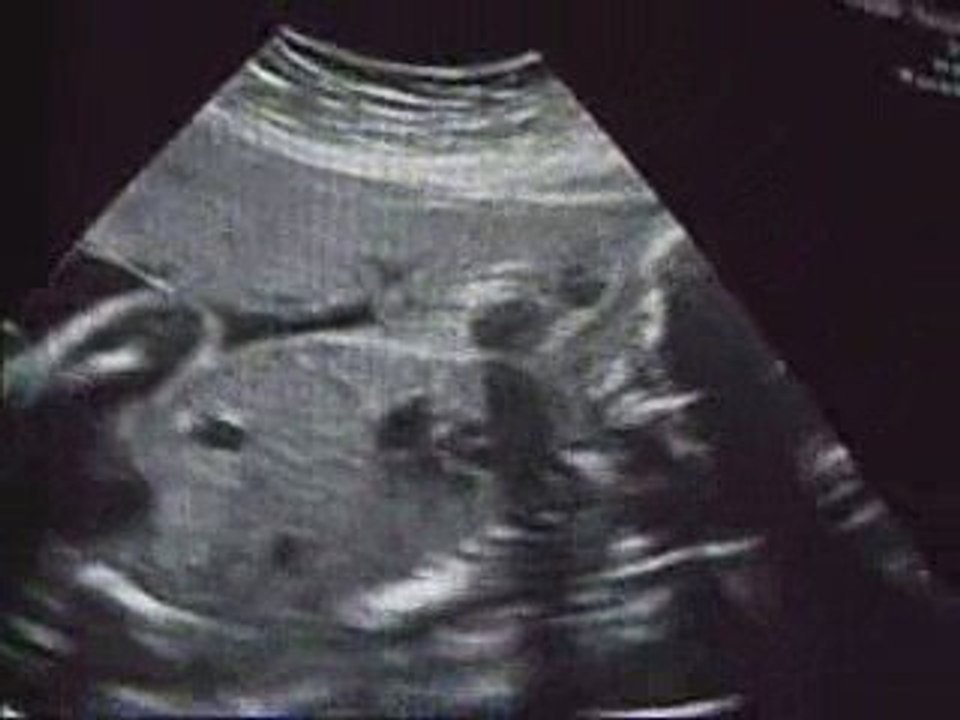 Echo du 5 mois de grossesse : Emma