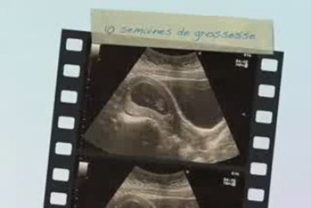 10 semaines de grossesse