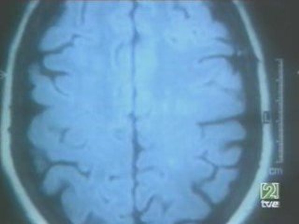 Esclerosis multiple: Hipotesis de la higiene