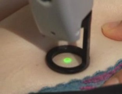 Traitement des taches rubis au laser