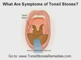 How To Get Rid Of Tonsil Stones