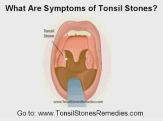 How To Get Rid Of Tonsil Stones