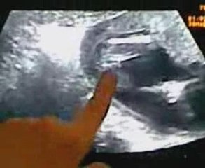 FILM échographie du 06 avril 2009.