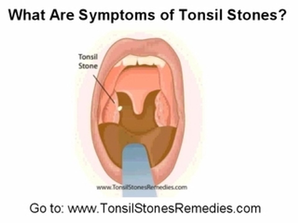 Throat Stones