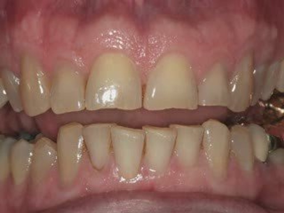 Dental Patient Education - Bruxism