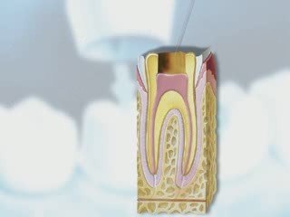 Dental Patient Education - Crowns