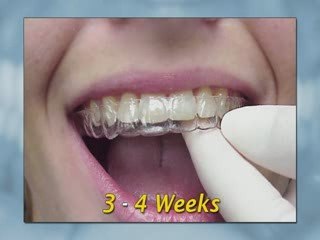 Dental Patient Education - Home Tooth Whitening