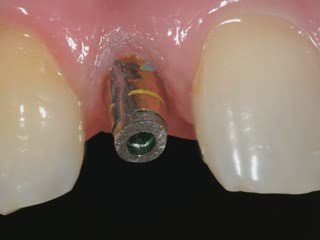 Dental Patient Education - Implant Placement