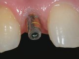 Dental Patient Education - Implant Placement
