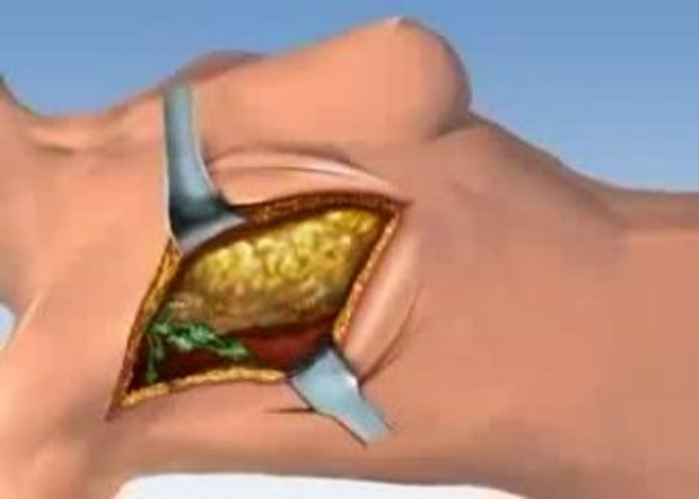 Breast Mastecomy Surgery